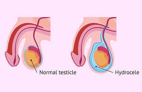  Hydrocele Surgery in Nanded