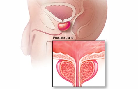  Prostate Surgery in Nanded 